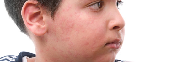 Childhood skin conditions & rashes