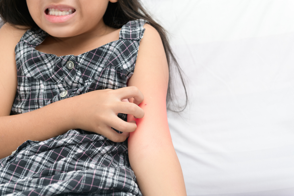 Eczema