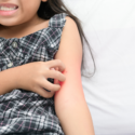 Feature image Eczema