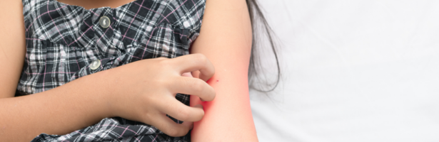 Eczema